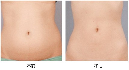 吸脂术